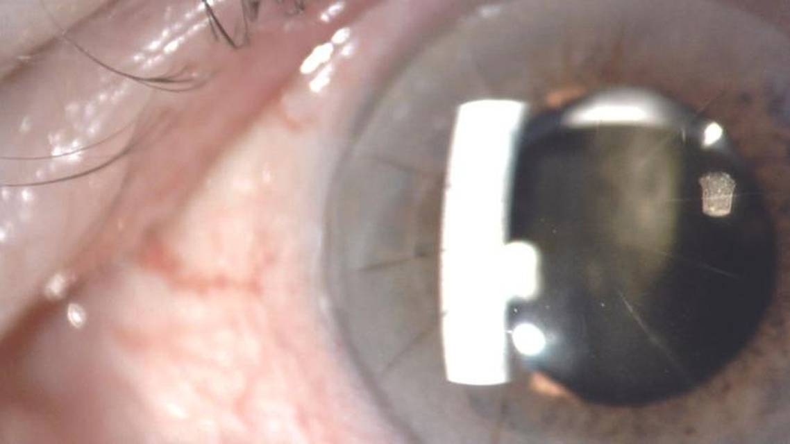 Worsening Vision From a Dislocated IOL