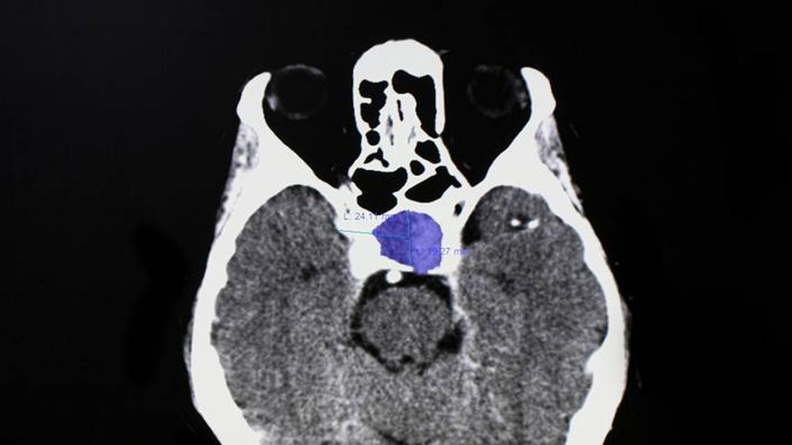 Ophthalmic Presentations of Pituitary Adenoma