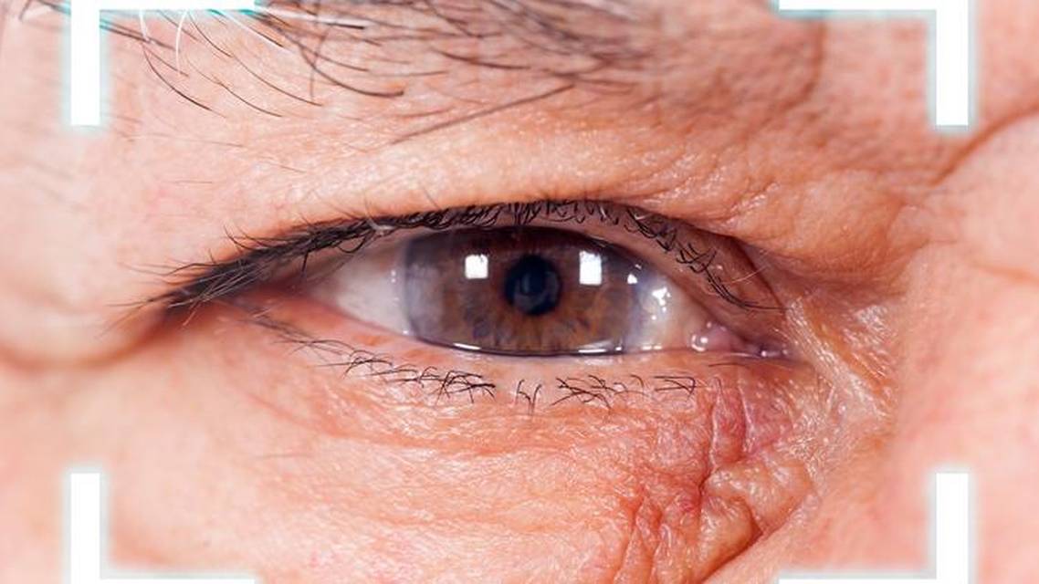 Cataract Surgery After SMILE