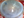 Figure 1. A hard cataract prolapsed into the anterior chamber.