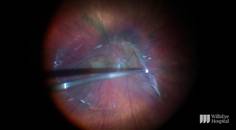 Complex Membrane Peel in Case of Combined Hamartoma thumbnail