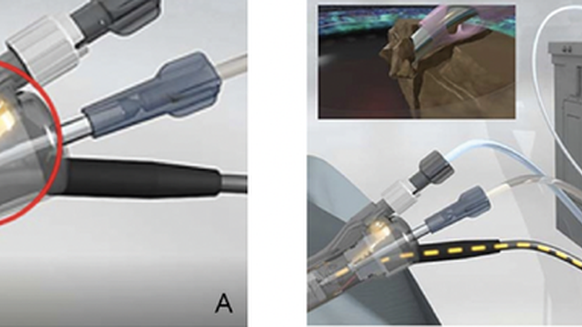 Surgical Performance of CENTURION Vision System with the ACTIVE SENTRY Handpiece