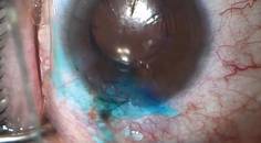 Wound Sealing and Stromal Hydration