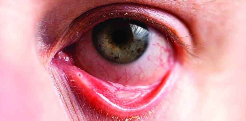 Approaches to Dry Eye Disease