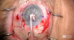 Corneal Edema in the Context of an Anterior Chamber IOL thumbnail