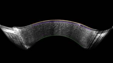 Oculus Unveils Cornea Segmentation Display for Pentacam Cornea OCT image
