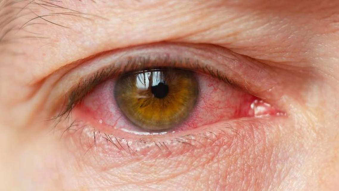 Aggressive Recurrent Inflammation After LASIK