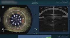 The Complete Refractive Cataract Surgery Package