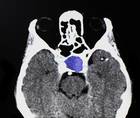 Ophthalmic Presentations of Pituitary Adenoma