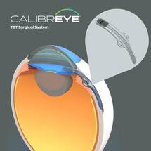 Myra Vision Enrolls First Patient in ADAPT Clinical Study of Calibreye Adjustable Glaucoma Shunt image