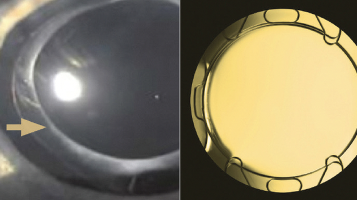 The FEMTIS IOL FamilyThe Perfect Match for FLACS Procedures