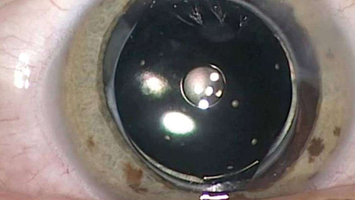 Off Label Use of Femtosecond Laser for Posterior Capsulotomy