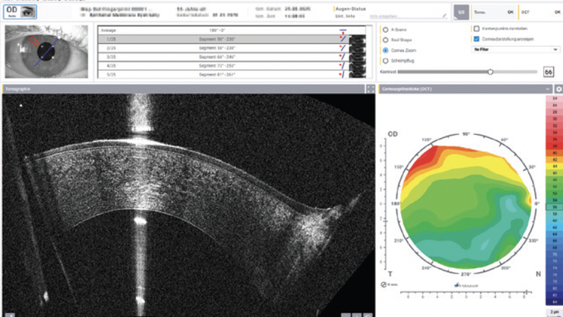 Augmented Awareness Supporting the Review Process with AI based Anomaly Detection in Corneal OCT