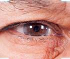Cataract Surgery After SMILE