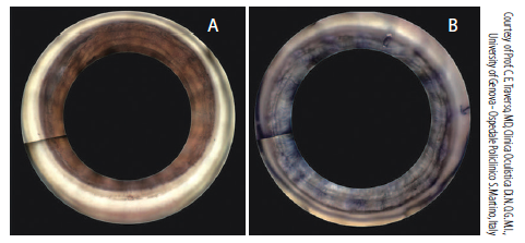 Automated Gonioscopy Improves the Ability to Review the Angle Anatomy