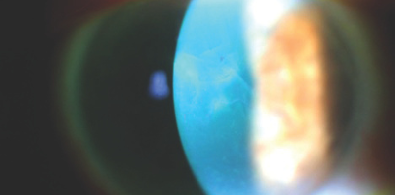 High Myopia After Cataract Surgery
