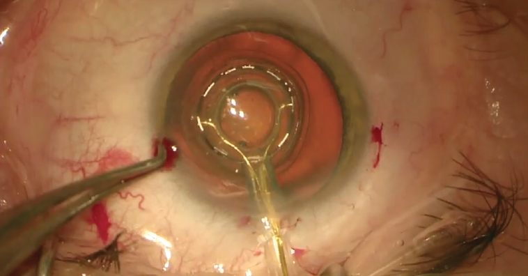 Zepto A viable Alternative to the Femtosecond Laser for FEMTIS IOL Implantation
