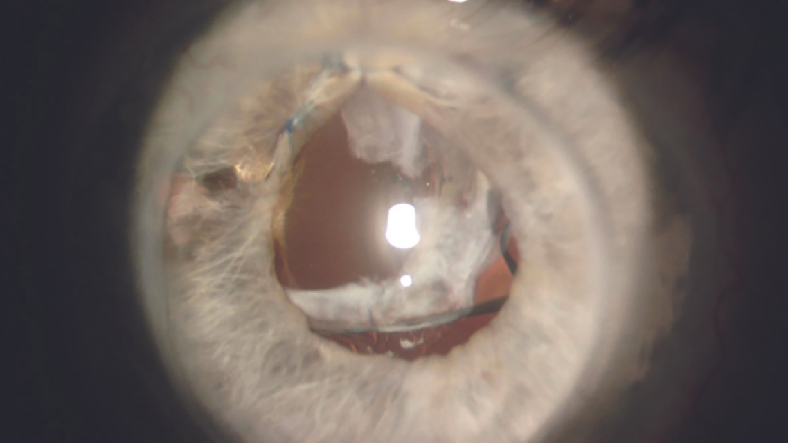 IOL Dislocation After Penetrating Keratoplasty