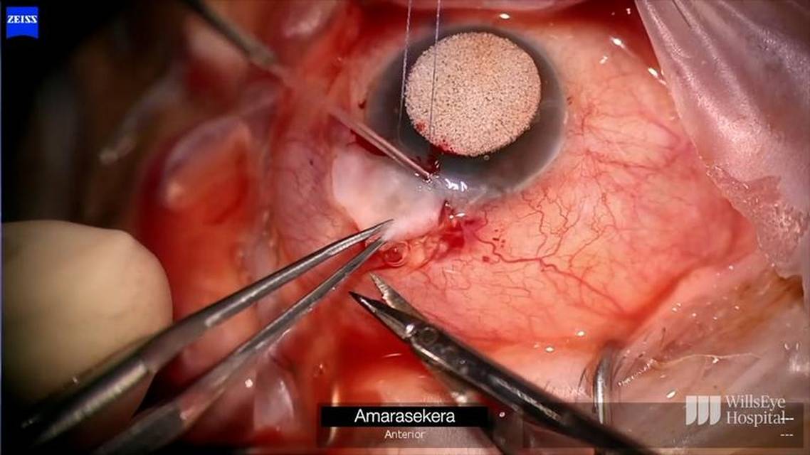 Choroidal Drainage and Repair of Bleb Leak thumbnail