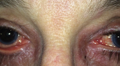 Early Intervention Is Best for Patients With Glaucoma