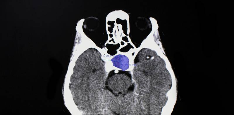 Ophthalmic Presentations of Pituitary Adenoma