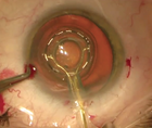 Zepto A viable Alternative to the Femtosecond Laser for FEMTIS IOL Implantation