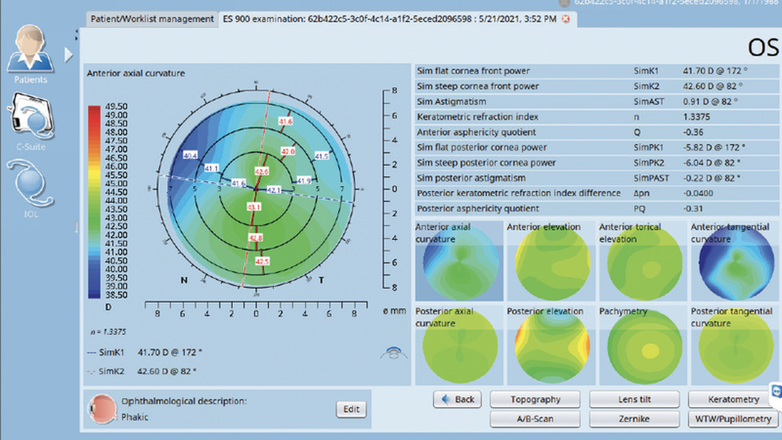 Clinical Value and Use of the Eyestar 900s Cataract Suite