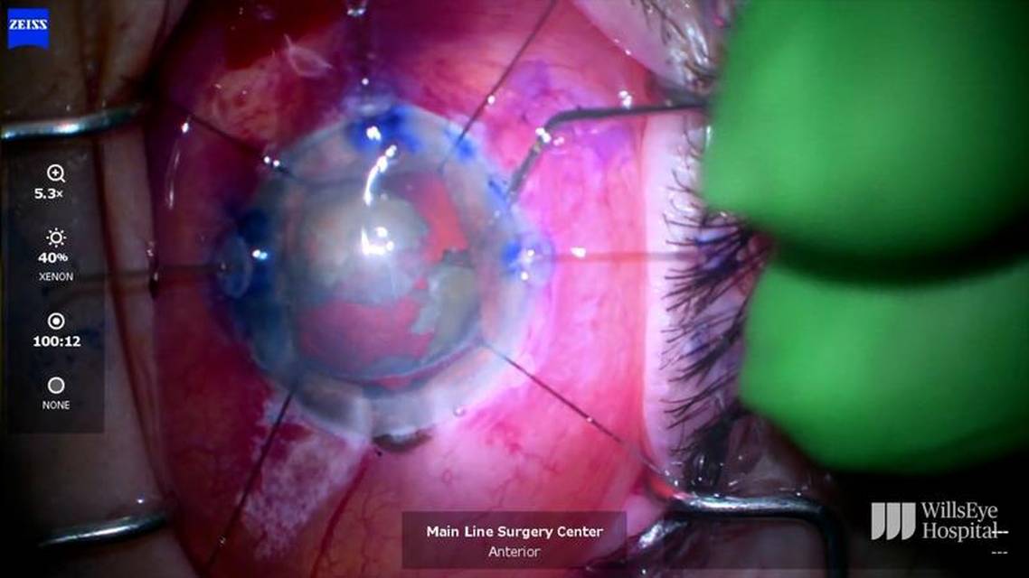 Dense Cataract in Pseudoexfoliation Syndrome thumbnail