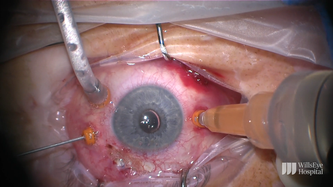 Total Retinal Detachment Repair With Lensectomy thumbnail