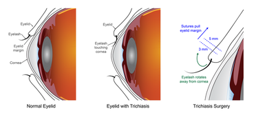 NIH Study Confirms Effectiveness of Eyelid Surgeries for Treating Trachomatous Trichiasis image