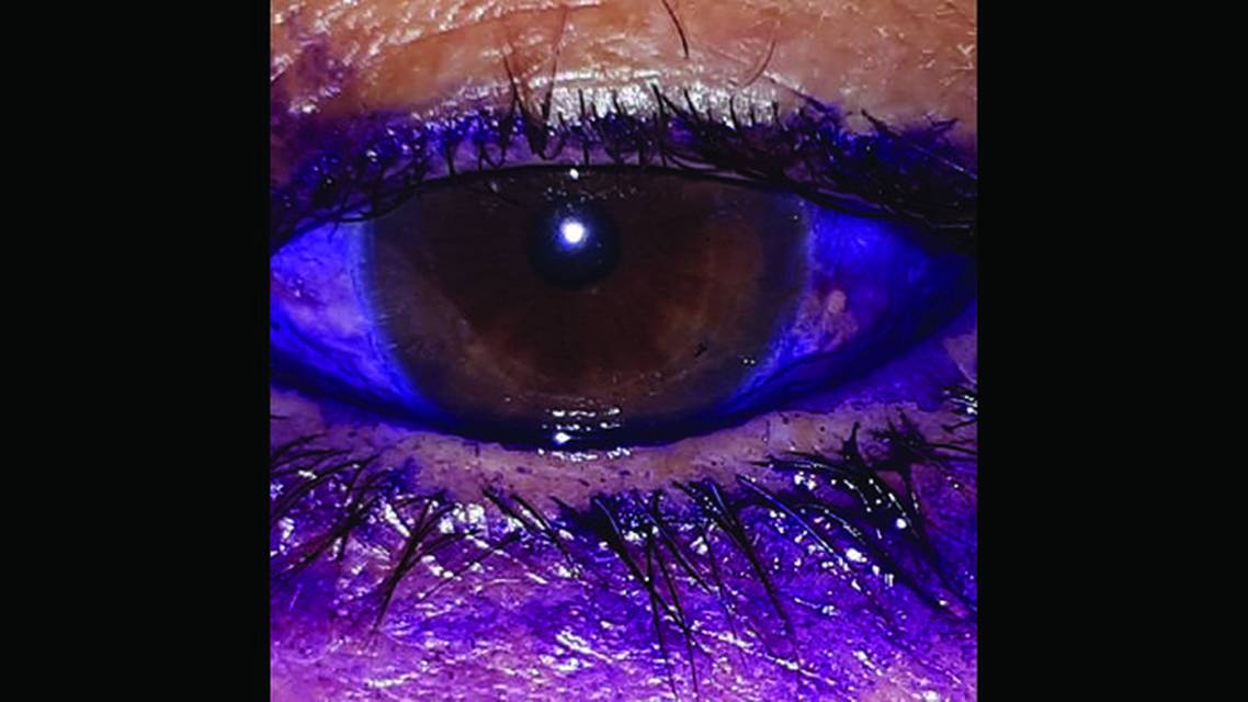 Dye Enhanced Laser Conjunctivoplasty for Conjunctivochalasis