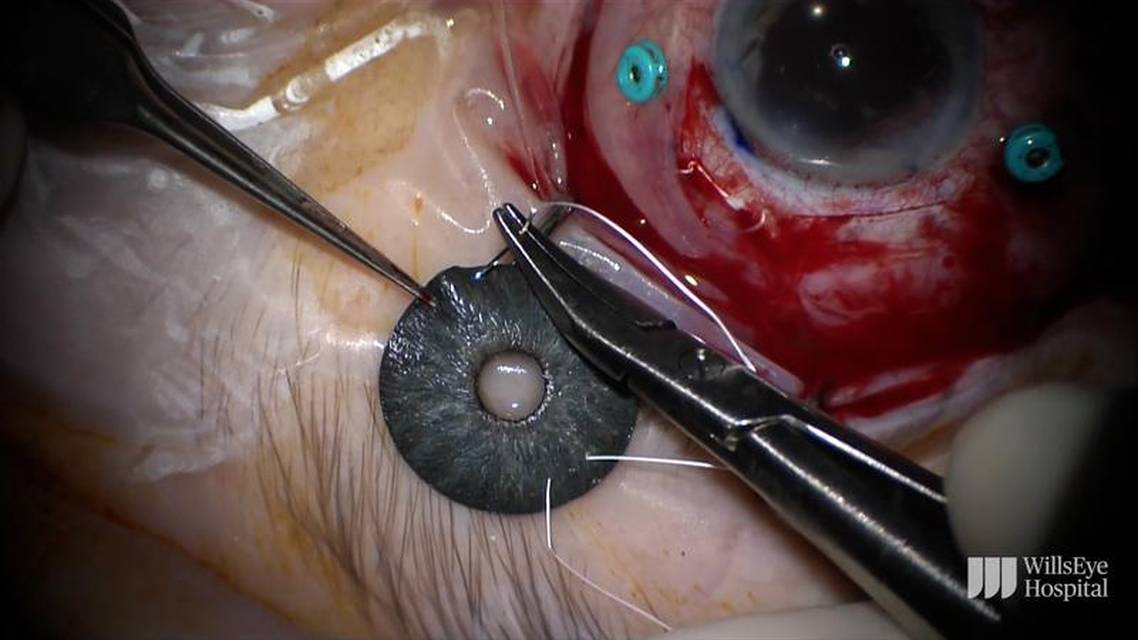 IOL Exchange and Iris Prosthesis thumbnail
