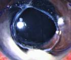 IOLCapsular Bag Complex in the Anterior Chamber