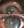 Figure 3. Severe limbal stem cell deficiency with loss of the anatomy of the fornix (A) and corneal vascularization and stromal scarring (B).