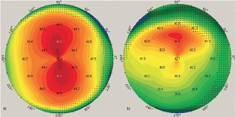Preoperative Steps in Presbyopic Cataract Surgery