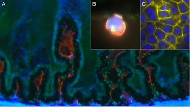 Research Challenges “Sugar Hypothesis” of Diabetic Cataract Development image