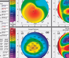 Keratoconus and Contact Lens Intolerance