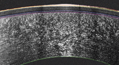 Layer by Layer Multi Zonal Thickness Mapping Unlocks a New Dimension in Corneal Diagnostics