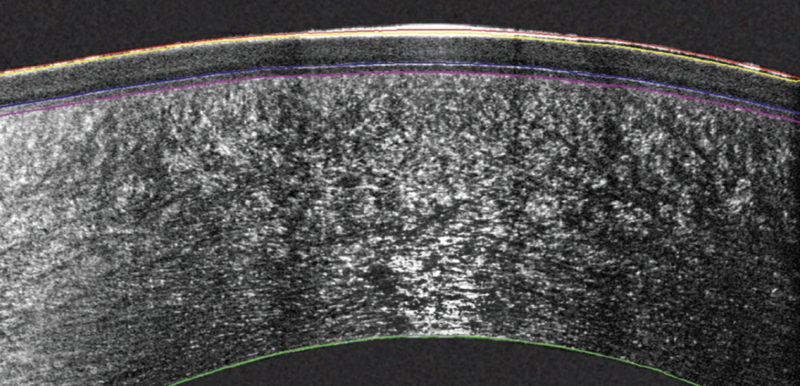 Layer by Layer Multi Zonal Thickness Mapping Unlocks a New Dimension in Corneal Diagnostics