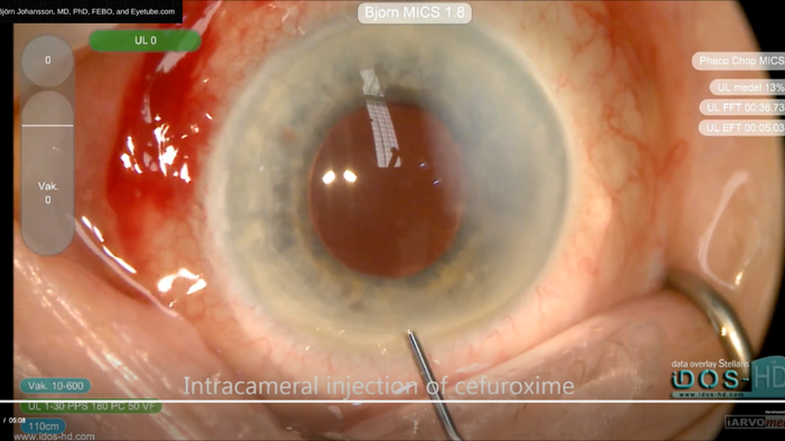 Suprachoroidal Hemorrhage