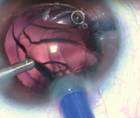 LACS and the FEMTIS IOL Best Practices With the CapsuLaser
