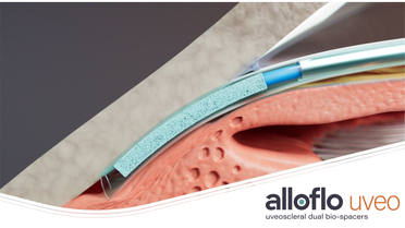 Iantrek Announces US Commercial Launch of AlloFlo Uveo, First Surgical Treatment Targeting the Uveoscleral Pathway image