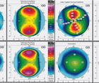 Extreme Astigmatism in a Pre Presbyopic Patient