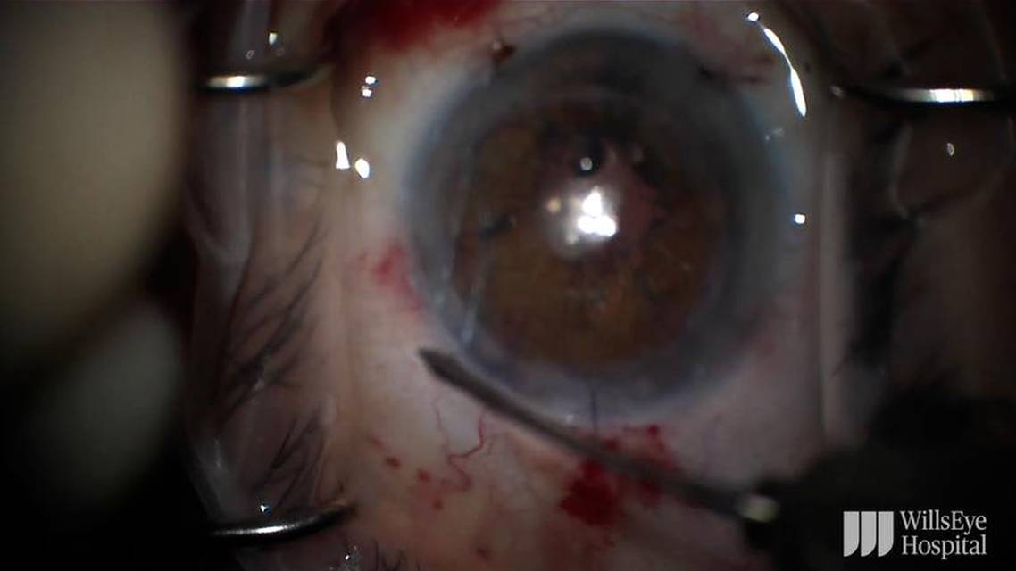 Traumatic Cataract With Repeat Pupillary Cerclage Under a Penetrating Keratoplasty thumbnail