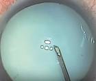 I Dont Have a Femtosecond Laser What Strategies Work Best for a White Cataract