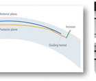 The CLEAR Advantage for Corneal Aberrations