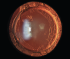 The YAG Capsulotomy The Final Hurdle to a Premium Visual Outcome