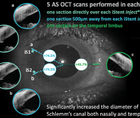 Trabecular Micro Bypass for the Treatment of Glaucoma