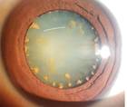 Ocular Siderosis Without a Detectable Intraocular Foreign Body
