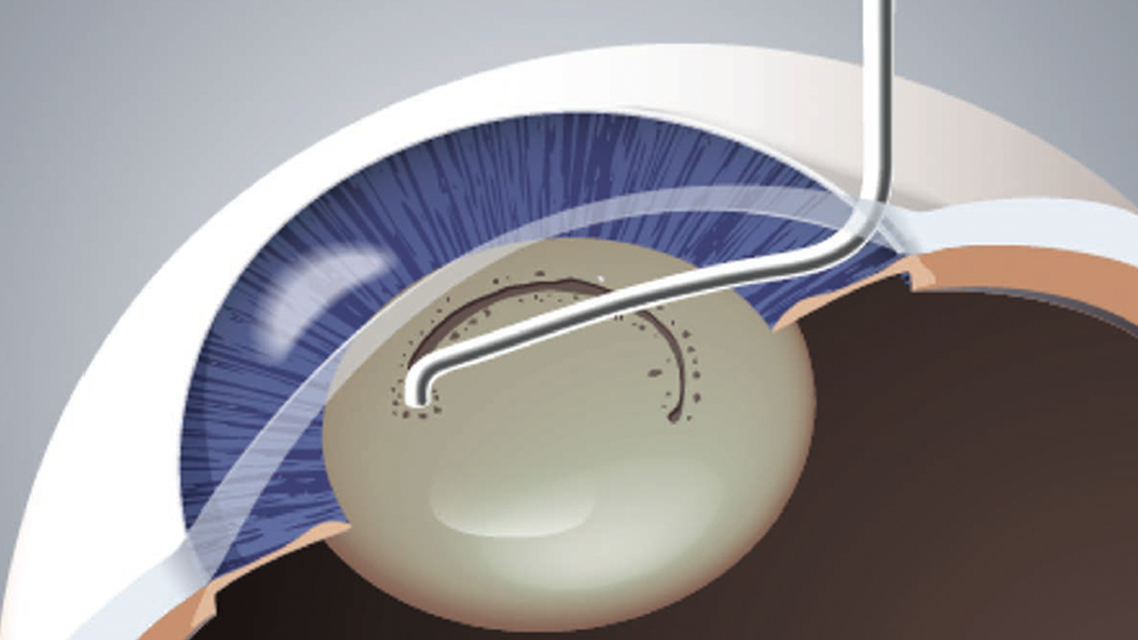 High Frequency Capsulotomy Technology